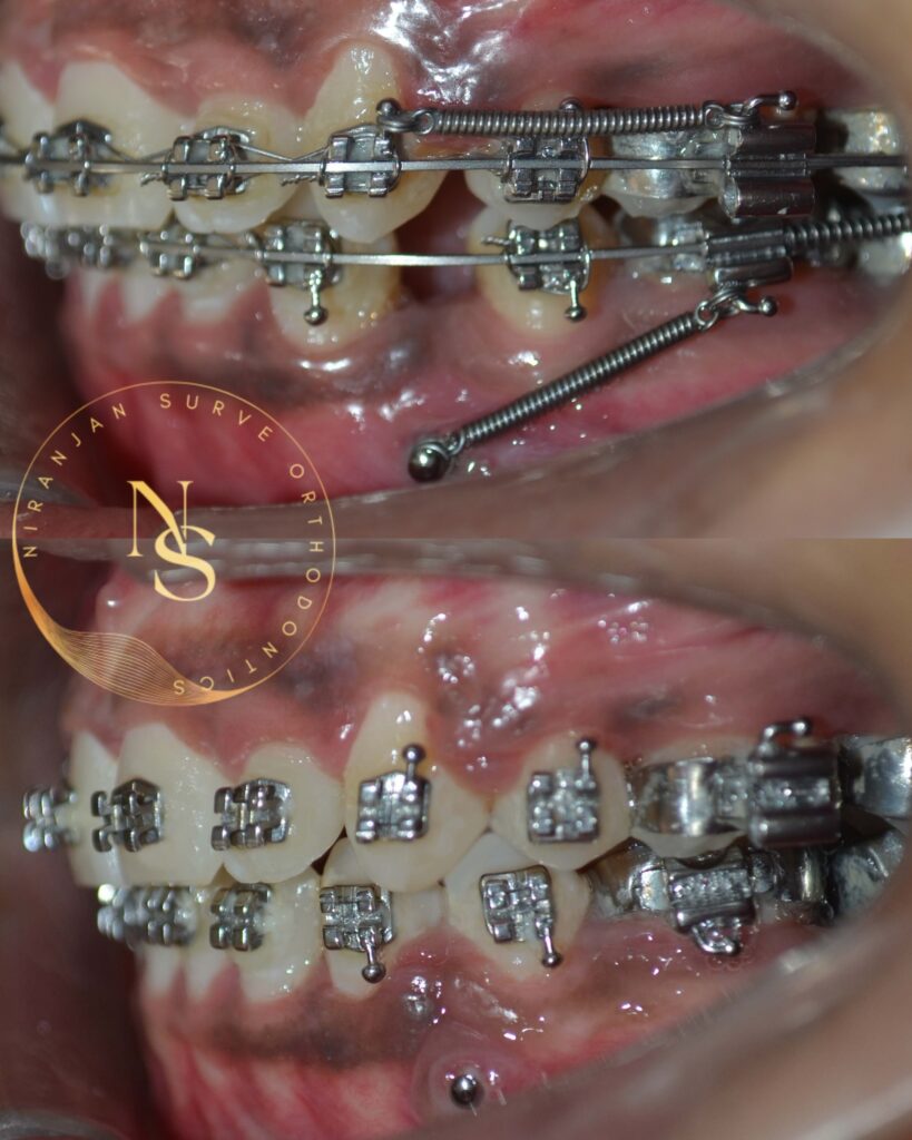 Regular braces