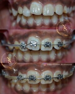 Regular braces