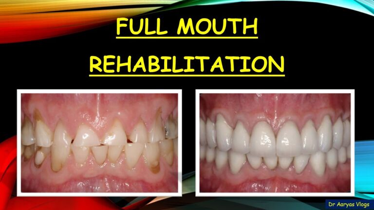 full mouth rehabilitation