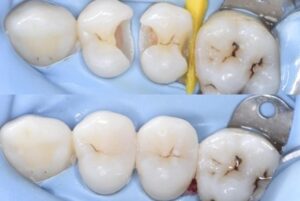 Dental filling in chikhali