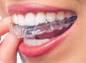 Invisalign and Clear Aligners​ in Pune