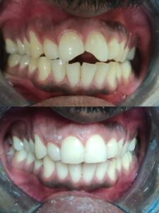 Dental filling in chikhali